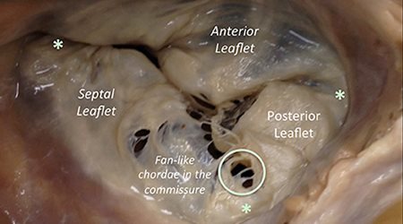 دریچه تریکوسپید  🔗