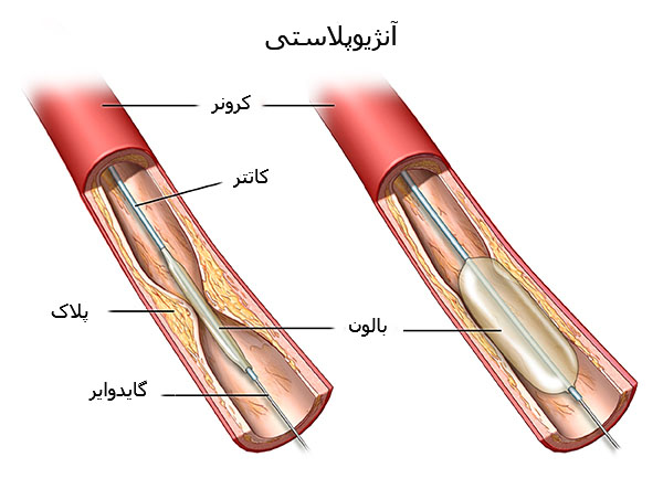 آنژیوپلاستی عروق کرونر