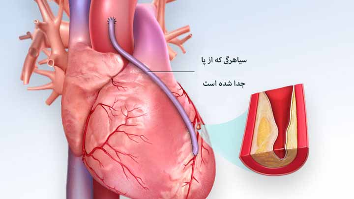 عمل بای پس قلب