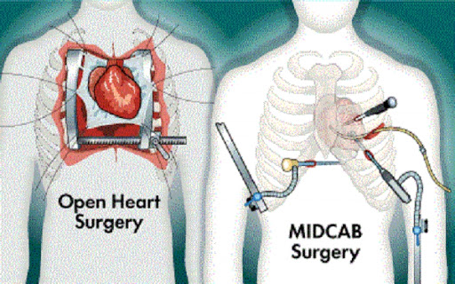 MIDCAB