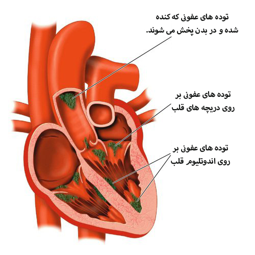 اندوکاردیت عفونی