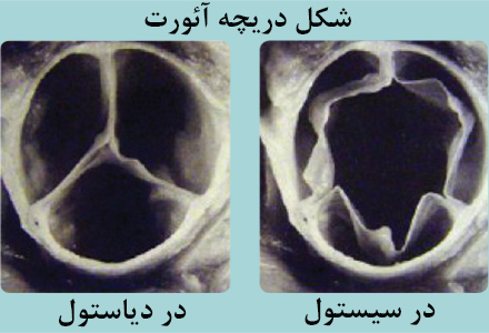 دريچه آئورت