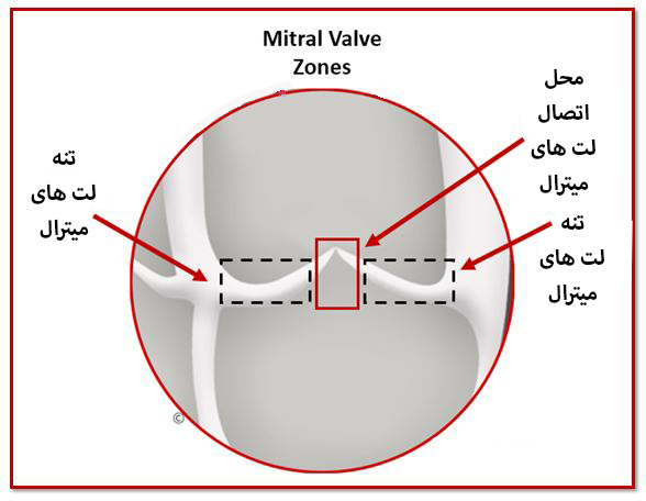 پرولاپس دريچه ميترال