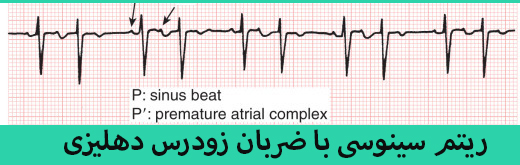 ضربان زودرس قلب