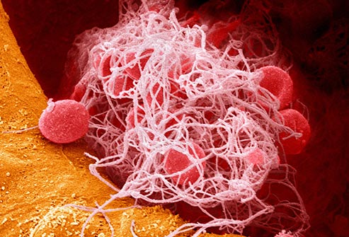 ترومبوز چیست؟ 🔗